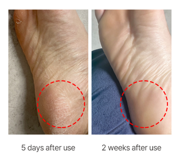 DERMAL Foot Peeling Mask Exfoliating AHA BHA PHA  Foot Care