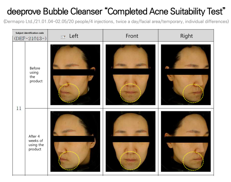 deeprove Ceramide Acne Bubble Cleanser 150ml